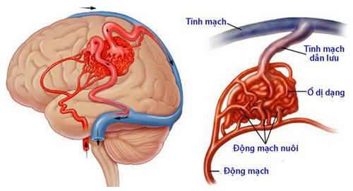 Dị dạng động mạch não