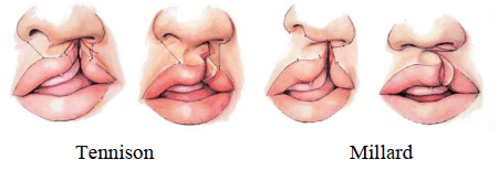 Dị tật bẩm sinh vùng hàm mặt khe hở môi- vòm miệng