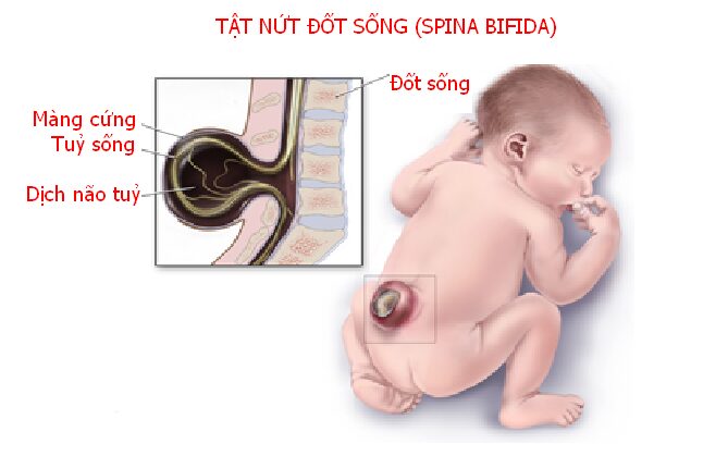 Dị tật cột sống chẻ tre