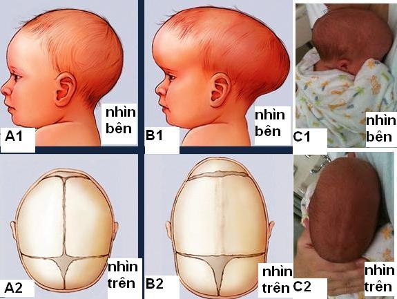 Dị tật dính khớp sọ sớm