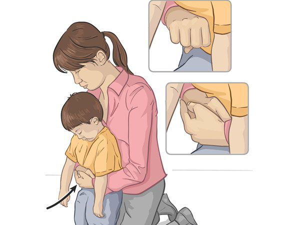 Dị vật đường thở ở trẻ em