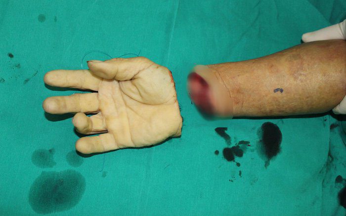 Điều trị vết thương đứt lìa và gần lìa chi ở trẻ em