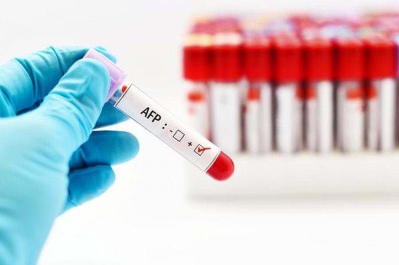 Định lượng AFP (Alphafetoprotein) bằng kỹ thuật miễn dịch phóng xạ