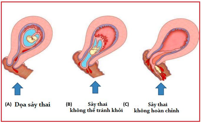 Dọa Sẩy Thai – Sẩy Thai