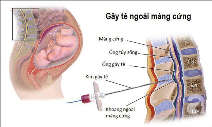 Gây Tê Ngoài Màng Cứng Giảm Đau Trong Chuyển Dạ
