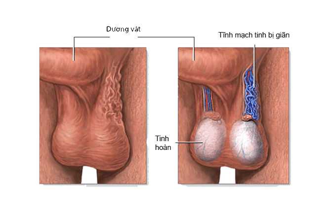 Giãn tĩnh mạch thừng tinh (Varicocele)