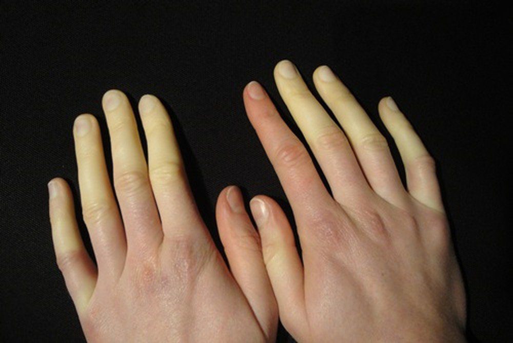 Hiện tượng Raynaud