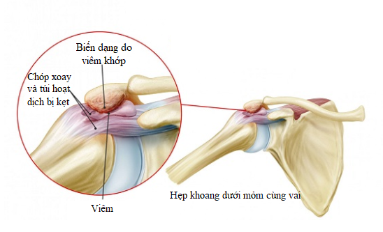 Hội chứng chèn ép khoang dưới mỏm cùng vai
