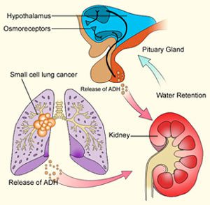 Hội Chứng Tiết ADH Không Thích Hợp (SIADH)