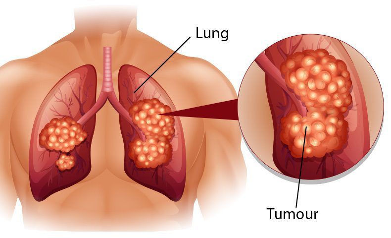 Hướng dẫn chẩn đoán ung thư phế quản nguyên phát