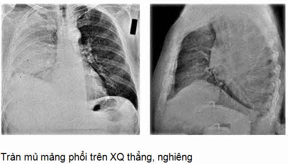 Hướng dẫn chẩn đoán và điều trị tràn mủ màng phổi – Bộ Y tế