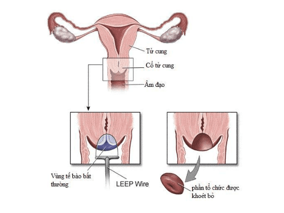 Khoét Chóp Cổ Tử Cung