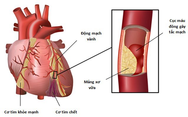 Kiểm soát Lipid máu trong phòng ngừa bệnh tim mạch do xơ vữa động mạch