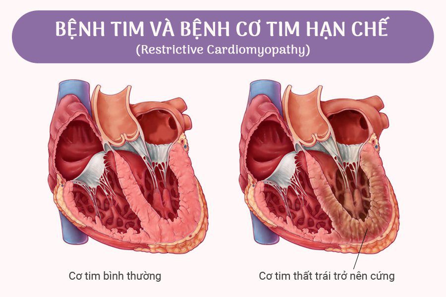 Lâm sàng tim mạch học: Bệnh cơ tim hạn chế