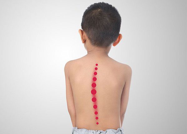 Lao cột sống ở trẻ em