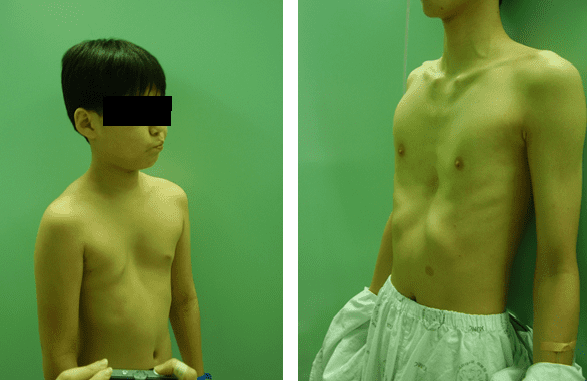 Lõm ngực bẩm sinh (Pectus Excavatum)
