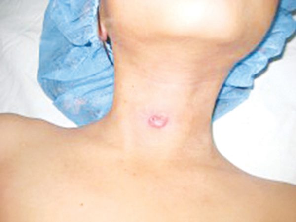 Nang và rò bẩm sinh vùng cổ