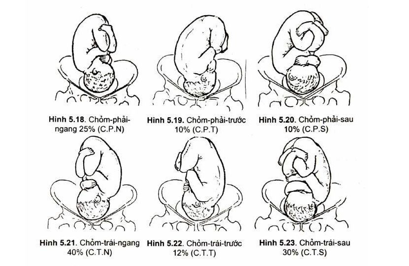 Nghiệm Pháp Lọt Ngôi Chỏm