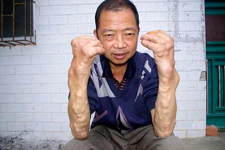 Ngộ độc chì