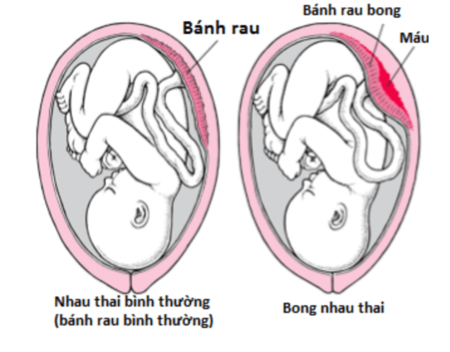 Nhau Bong Non