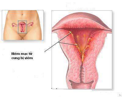 Nhiễm Khuẩn Hậu Sản