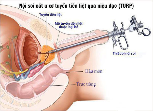 Nội soi cắt u niệu đạo, van niệu đạo