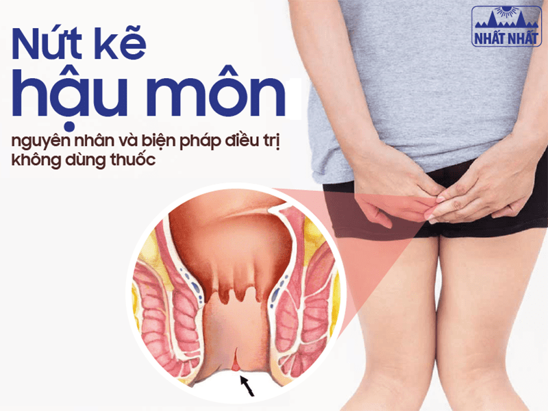Nứt kẽ hậu môn