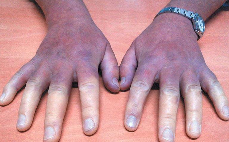 Phác đồ chẩn đoán và điều trị xơ cứng bì toàn thể