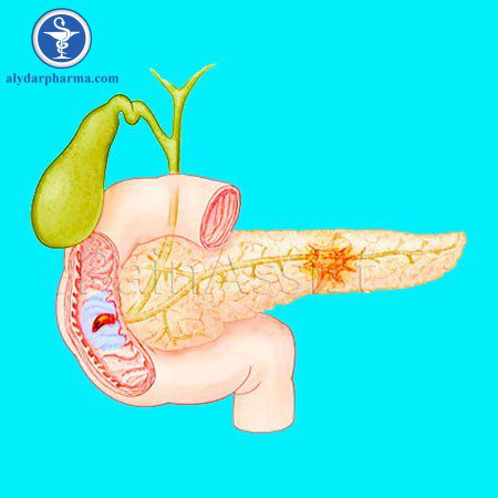 Phác Đồ Viêm Tụy Cấp – BV Bạch Mai