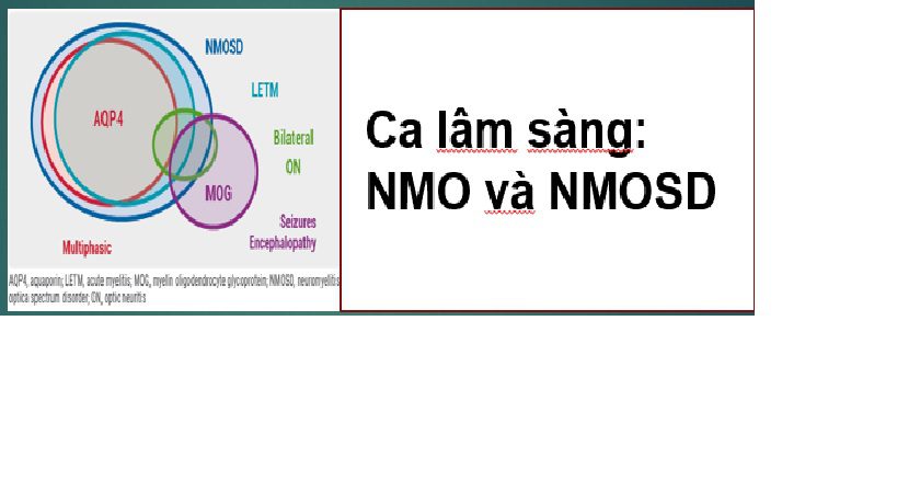 Phân tích ca lâm sàng cấp cứu thần kinh: chóng mặt đơn thuần