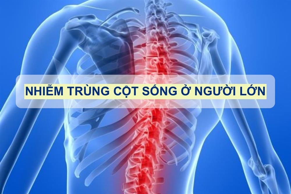 Phân tích ca lâm sàng cấp cứu thần kinh: Đau đầu nặng kháng thuốc