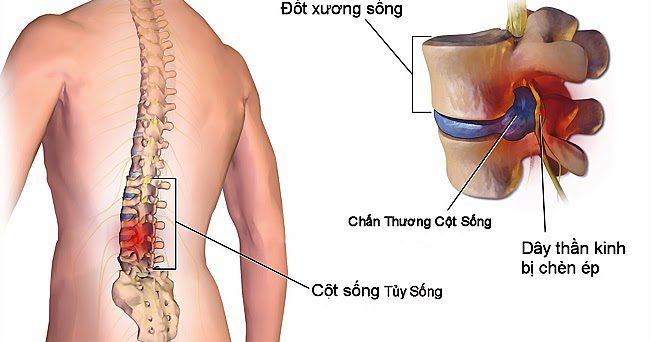 Phân tích ca lâm sàng cấp cứu thần kinh: liệt 2 chi dưới sau chấn thương