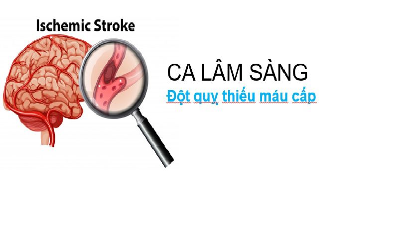 Phân tích ca lâm sàng: đột quỵ vì thuyên tắc mạch do tim chống chỉ định dùng chống đông