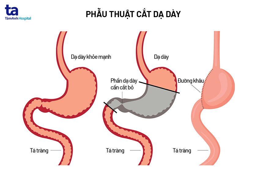 Phẫu thuật cắt dạ dày trong điều trị bệnh loét dạ dày – tá tràng