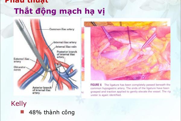 Phẫu Thuật Thắt Động Mạch Hạ Vị