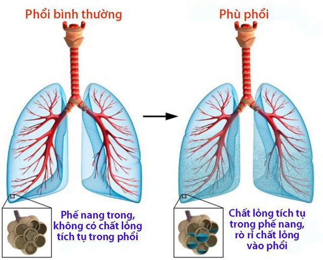 Phù Phổi Cấp