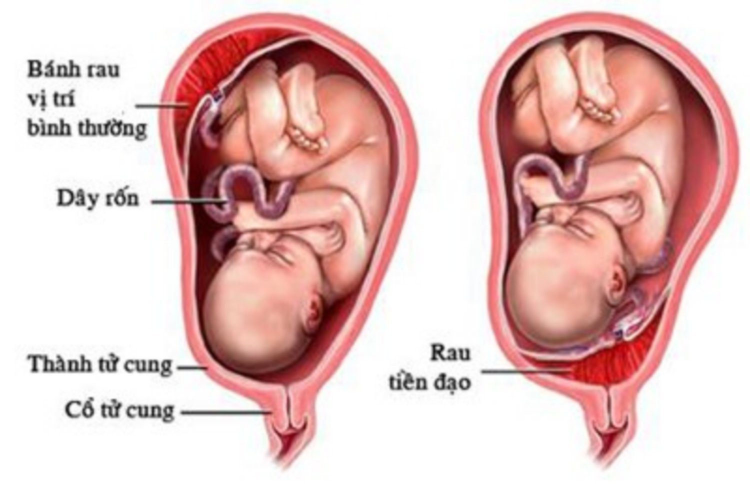 Rau Tiền Đạo