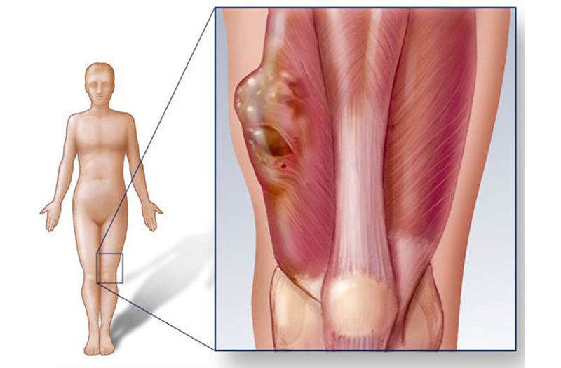 Sarcoma cơ vân