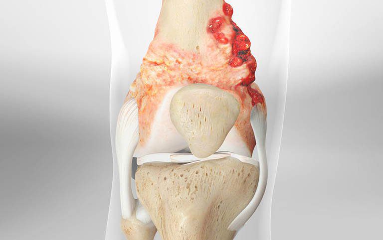 Sarcoma xương