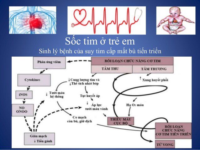Sốc Tim Trẻ Em