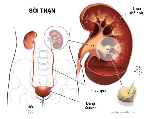 Sỏi đường tiết niệu