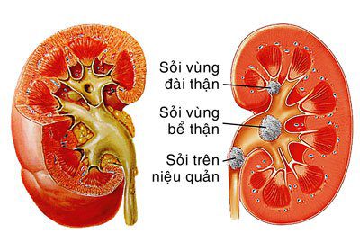 Sỏi thận-tiết niệu