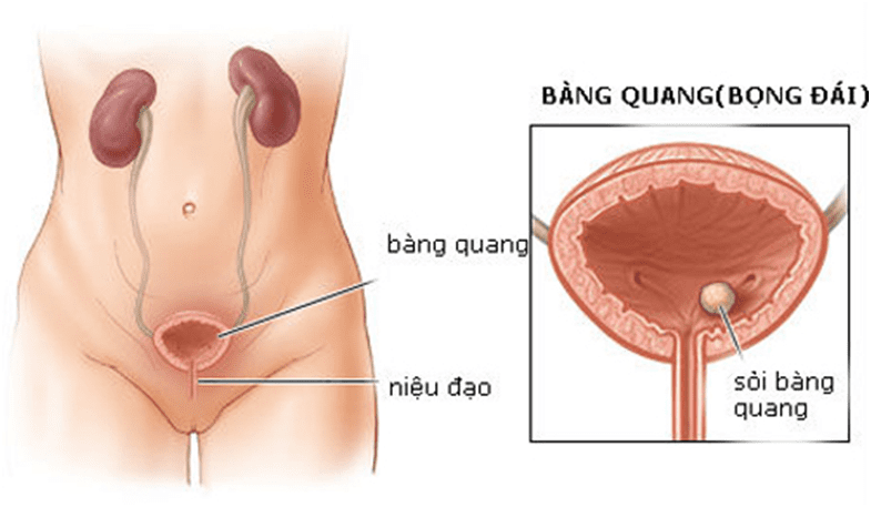 Sỏi tiết niệu ở trẻ em