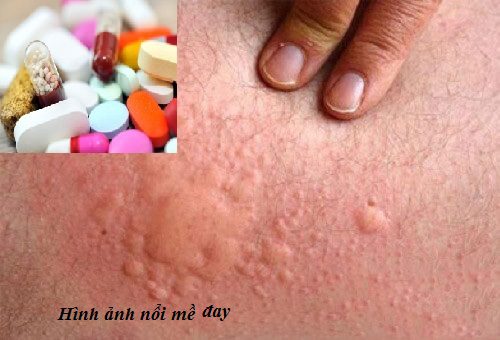 Sử dụng thuốc kháng histamine h1 trong một số bệnh dị ứng