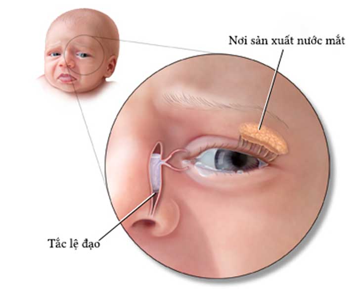 Tắc lệ đạo bẩm sinh