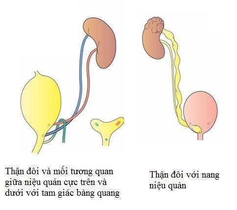 Thận và niệu quản đôi