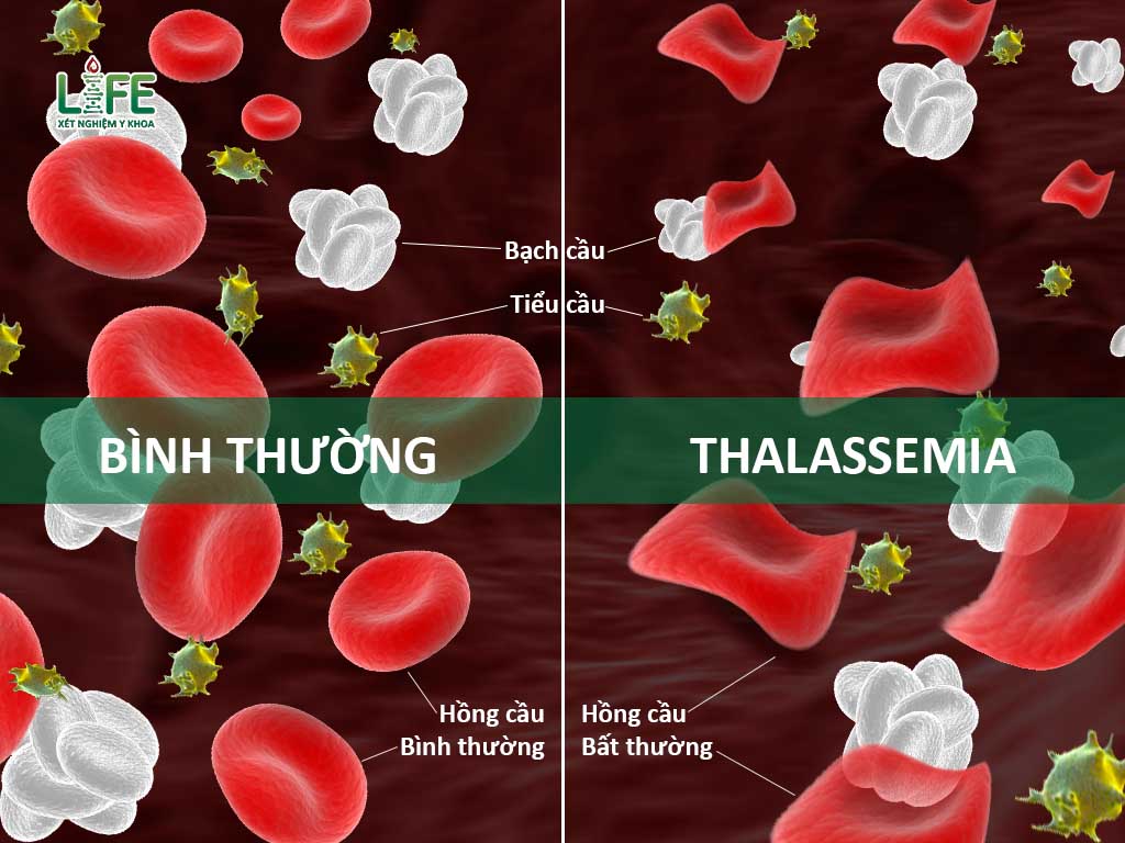 Thiếu máu tan máu