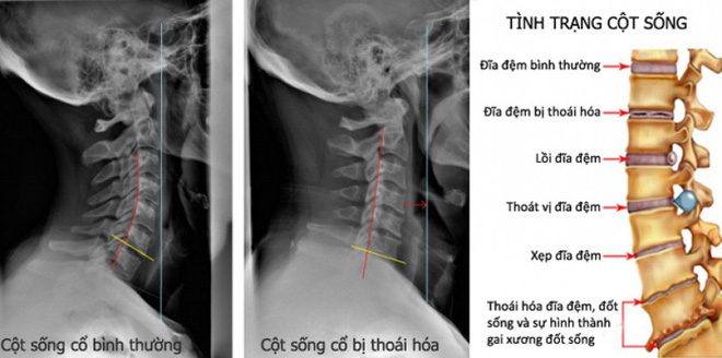 THOÁI HÓA CỘT SỐNG CỔ(Cervical spondylosis)