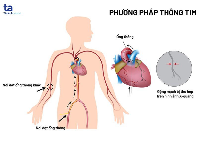 Thông Tim Và Chụp Mạch Vành