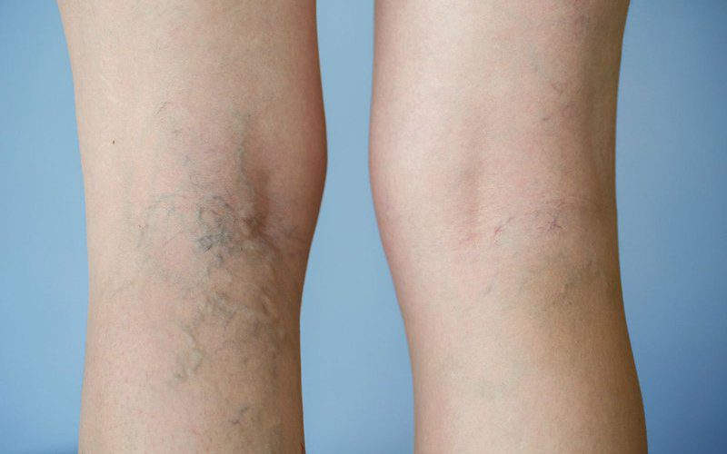 Tiêm xơ điều trị suy tĩnh mạch mạn tính chi dưới